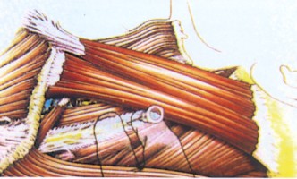 Figure 1. Needle insertion into the interscalene groove for brachial plexus block