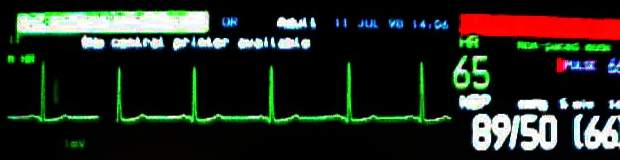 Corrected ECG