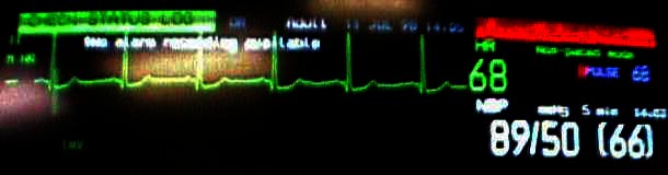 Uncorrected ECG